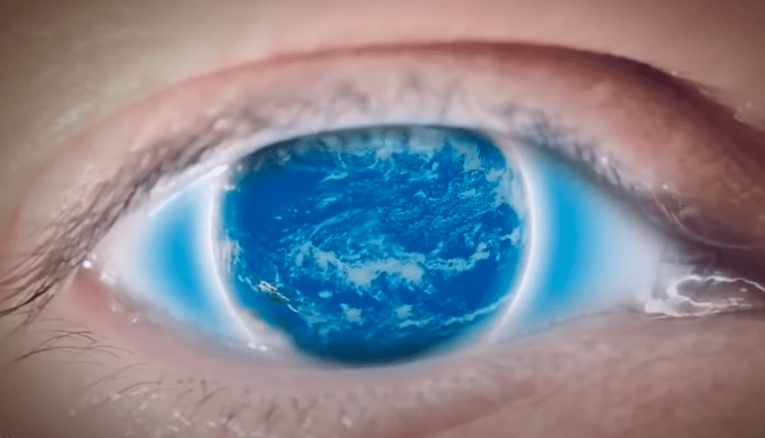 Eye with Globe